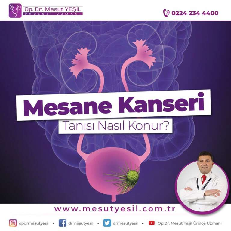 Mesane Kanseri ( İdrar Torbası Tümörü ) Üroloji Bursa Böbrek Mesane Kanseri ( İdrar Torbası Tümörü ) Üroloji Bursa Böbrek
