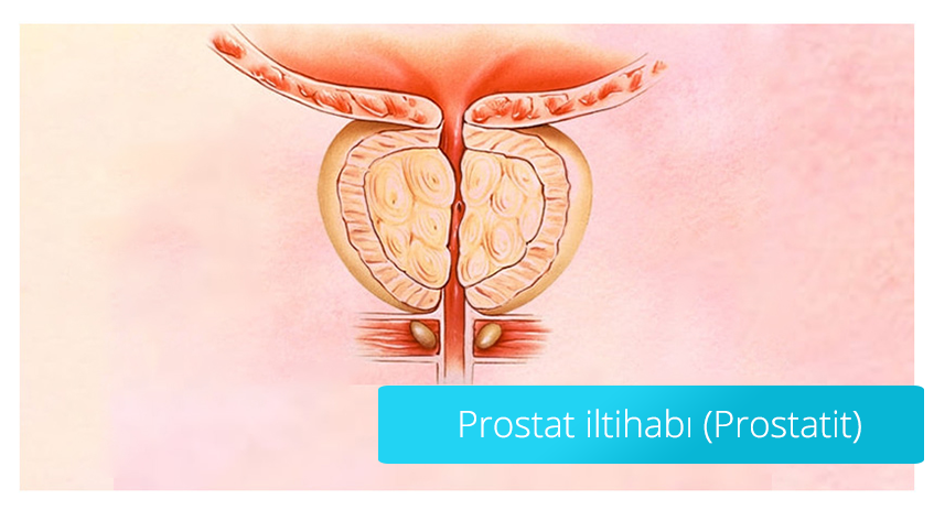 Prostatit (Prostat İltihabı)
